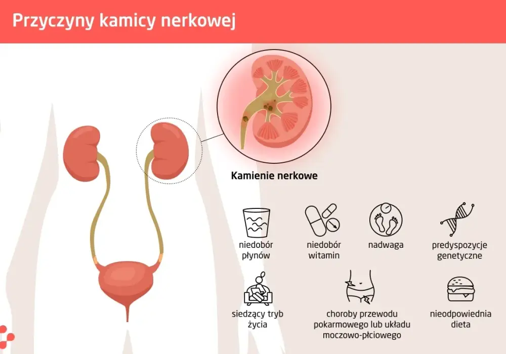 Przyczyna kamicy nerkowej – poznaj czynniki ryzyka i ich skutki