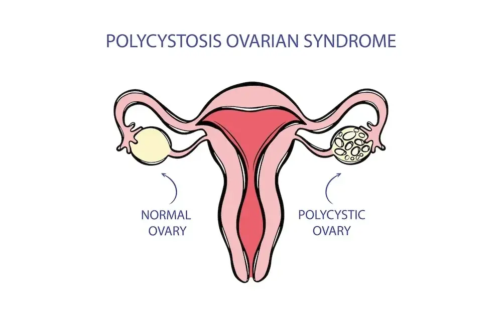 PCOS: jakie badania krwi są kluczowe dla diagnozy i zdrowia jajników?