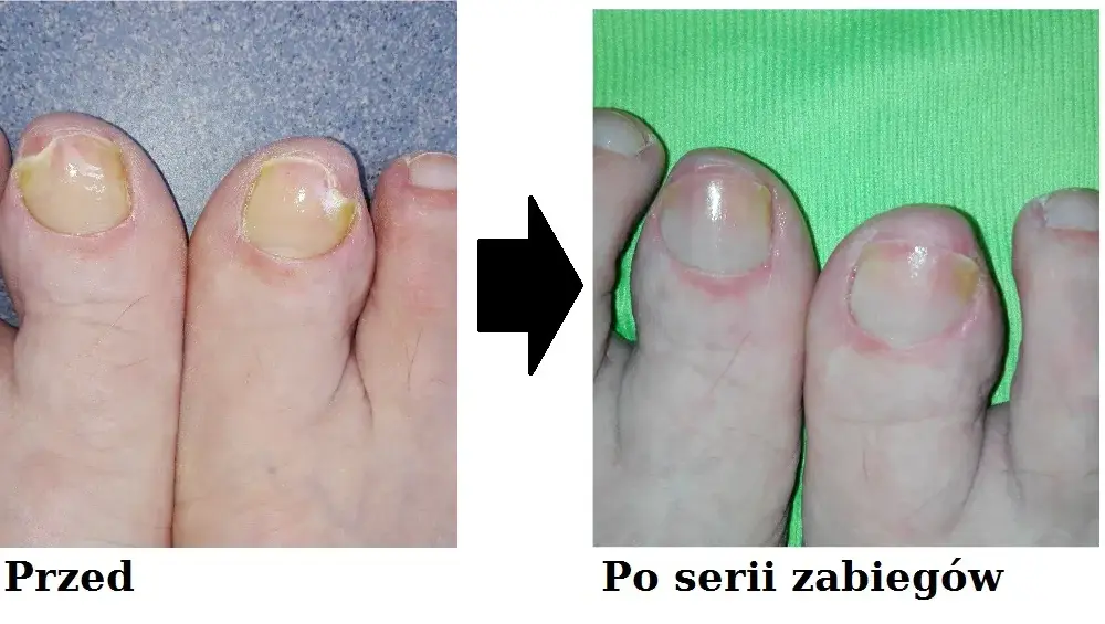 Grzybica paznokci - który lekarz najskuteczniej wyleczy tę chorobę?