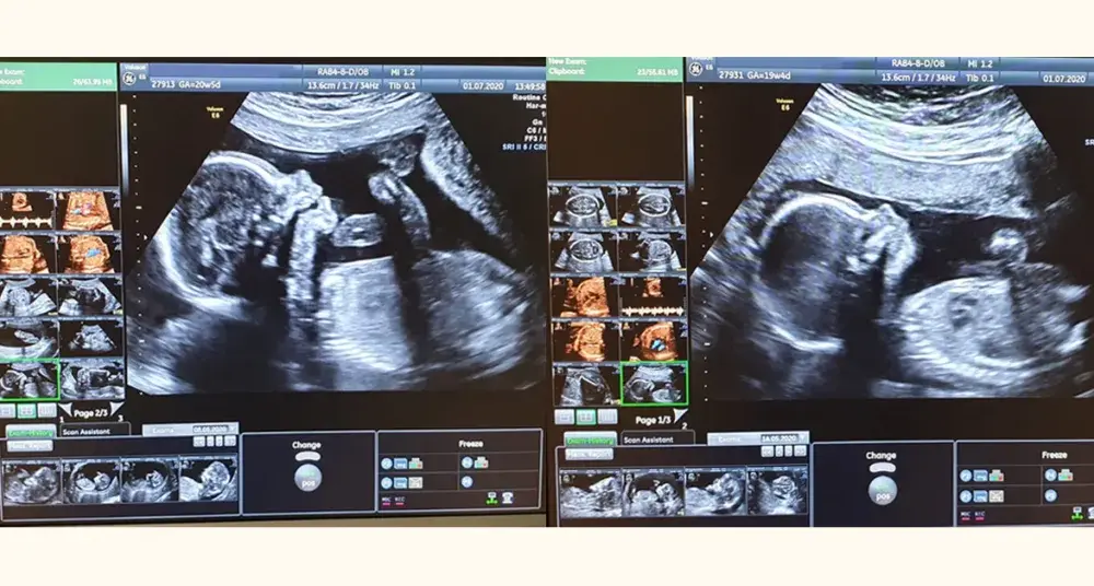 Badania prenatalne - sprawdź terminy wykonania każdego badania w ciąży