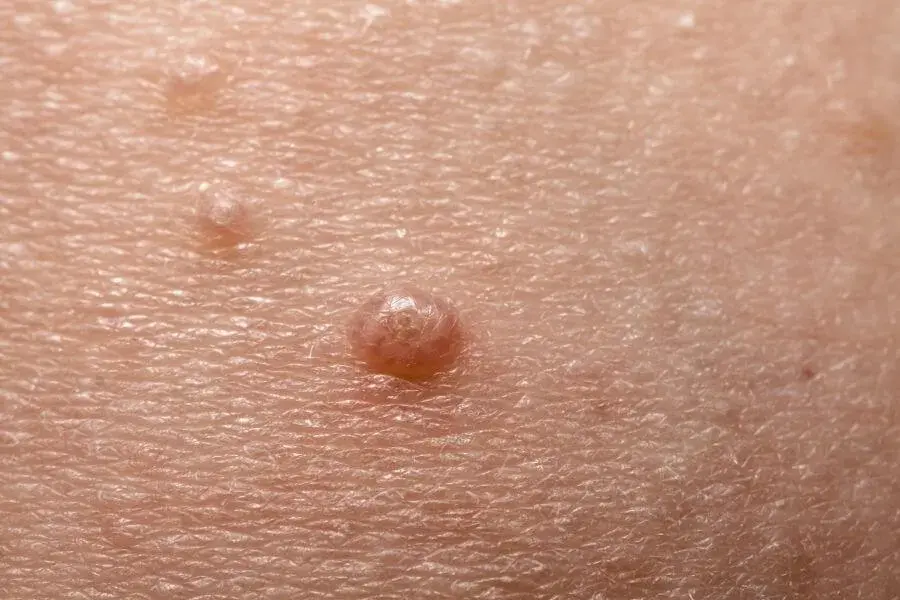 Jakie są objawy mięczaka zakaźnego? Poznaj 7 najczęstszych symptomów