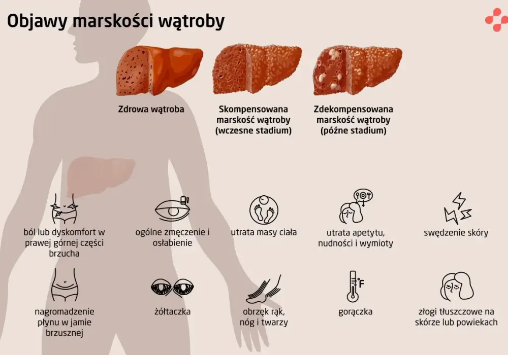 Marskość wątroby - objawy, które łatwo przeoczyć. Sprawdź!