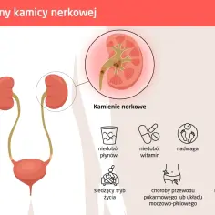 Przyczyna kamicy nerkowej – poznaj czynniki ryzyka i ich skutki