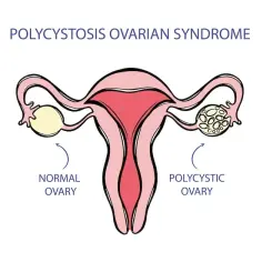 PCOS: jakie badania krwi są kluczowe dla diagnozy i zdrowia jajników?