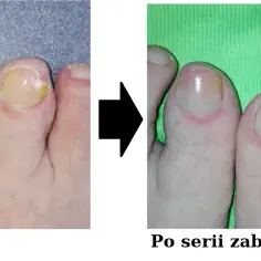 Grzybica paznokci - który lekarz najskuteczniej wyleczy tę chorobę?