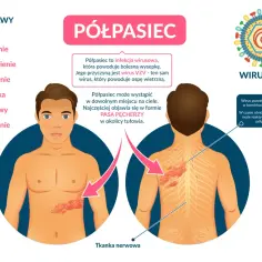 Czy półpasiec jest zakaźny - fakty o przenoszeniu choroby, które musisz znać