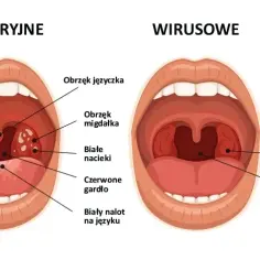 Czy angina jest zakaźna? Poznaj okres zarażania i skuteczną profilaktykę