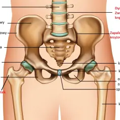Anatomia miednicy z zaznaczonym stawem biodrowym, kością krzyżową i udową. Widoczne zapalenie kaletek i przeciążenie ścięgien.