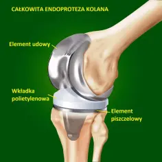 Najszybsze terminy na endoprotezę stawu kolanowego NFZ: lista placówek