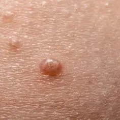 Jakie są objawy mięczaka zakaźnego? Poznaj 7 najczęstszych symptomów