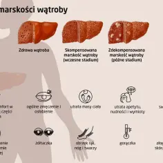 Ilustracja przedstawia objawy marskości wątroby: ból brzucha, zmęczenie, utratę masy ciała, żółtaczkę, obrzęki, gorączkę i swędzenie skóry.