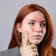 Czerwona wysypka na twarzy, szczególnie na policzkach i nosie, może być jednym z pierwszych objawów tocznia.