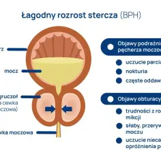 Ilustracja przedstawia łagodny rozrost stercza (BPH), gdzie powiększony gruczoł uciska cewkę moczową, powodując objawy podrażnienia i obturacyjne.