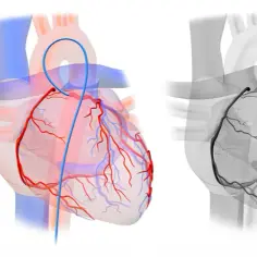 Koronarografia – Kluczowe Badanie Diagnostyczne Stanu Twojego Serca