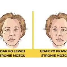 Który udar jest groźniejszy: prawostronny czy lewostronny? Porównanie skutków i rokowania
