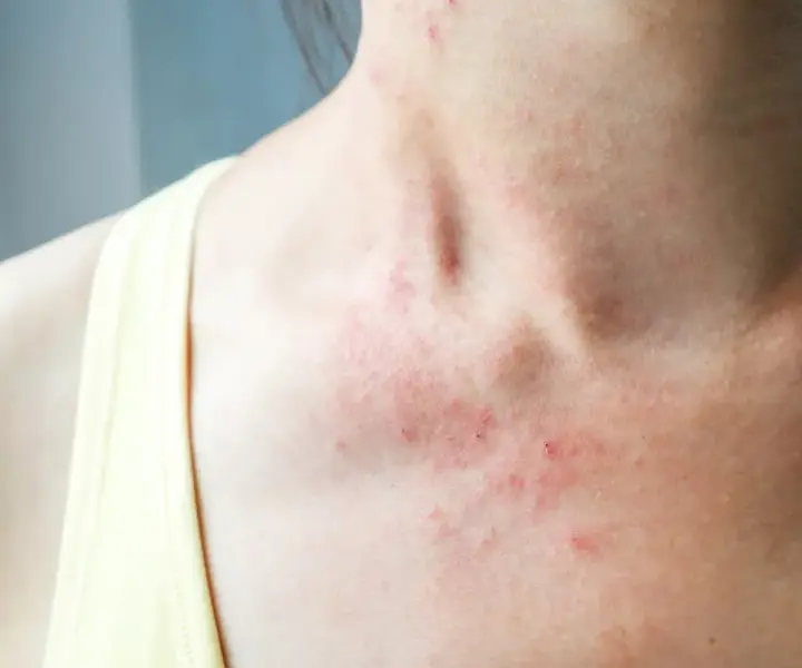Czy rabarbar uczula? Objawy alergii, które warto znać