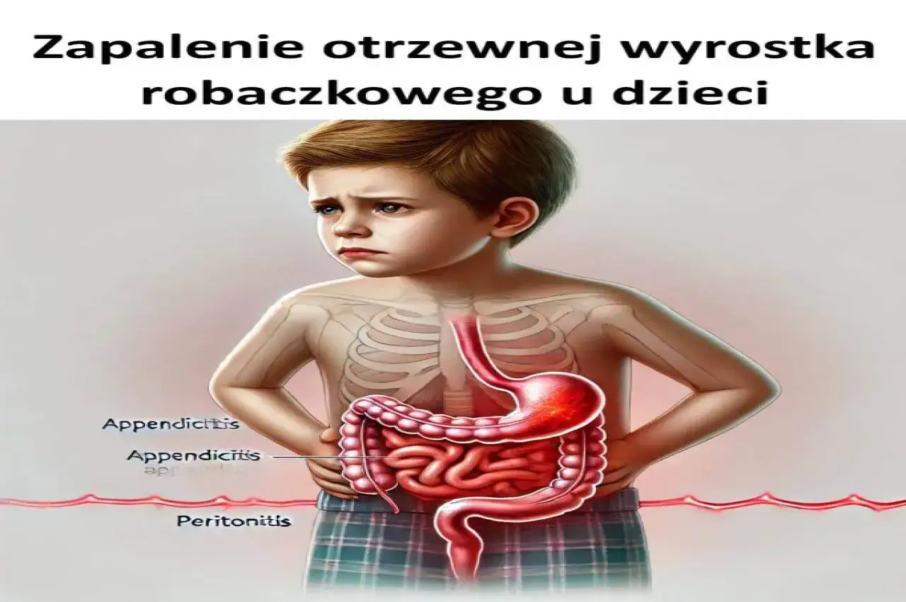 Chłopiec z bólem brzucha, ilustracja przedstawia zapalenie otrzewnej wyrostka robaczkowego.
