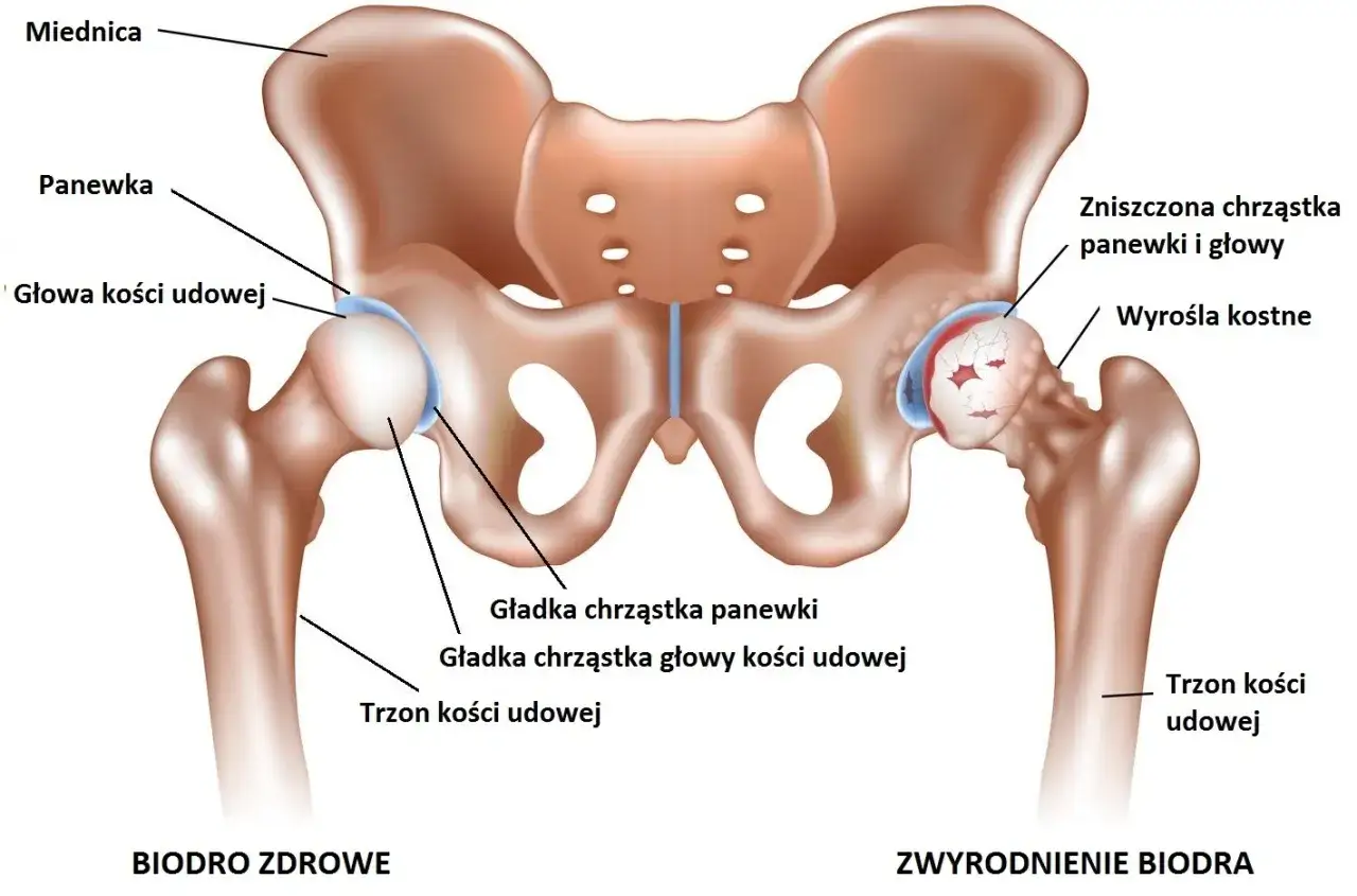 Porównanie zdrowego stawu biodrowego z jego zwyrodniałą formą, ukazując zniszczoną chrząstkę i wyrośla kostne.