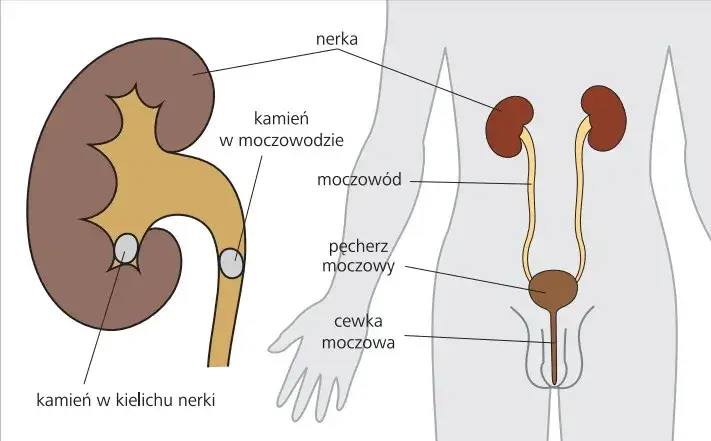 Zdjęcie Przyczyna kamicy nerkowej – poznaj czynniki ryzyka i ich skutki