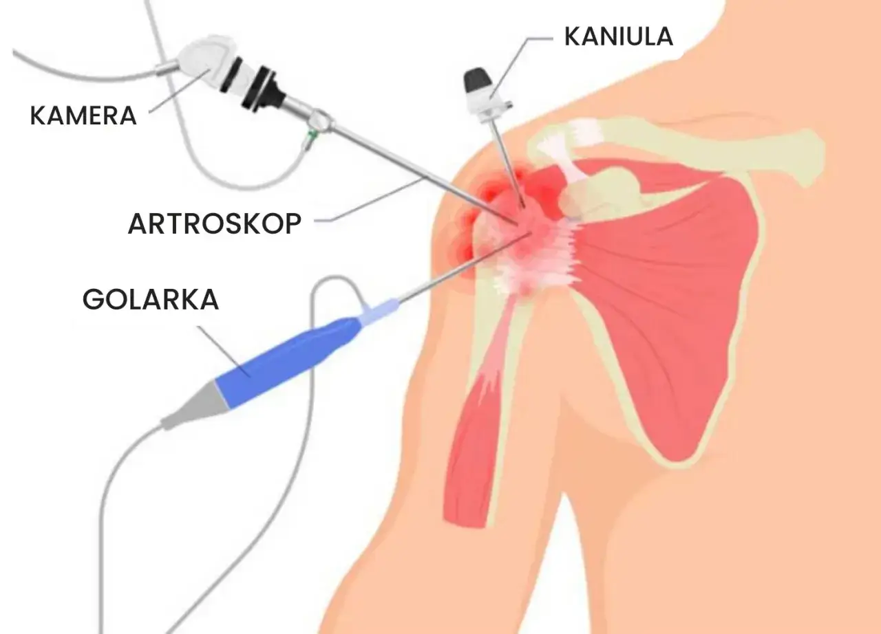 Zdjęcie Artroskopia barku NFZ - terminarz najkrótszych kolejek w Polsce 2025