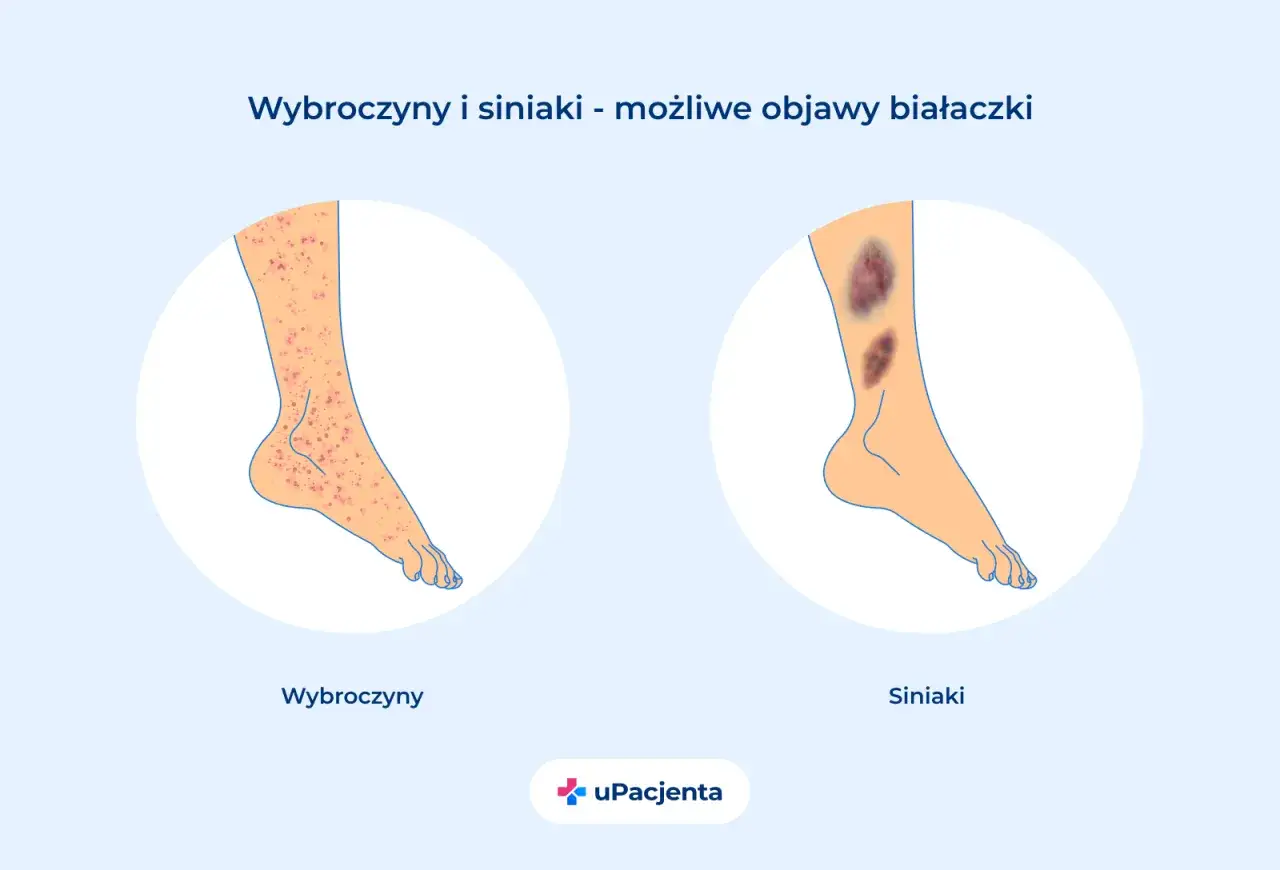 Wybroczyny i siniaki na nogach mogą być objawami białaczki. Ilustracja pokazuje obie te zmiany skórne.