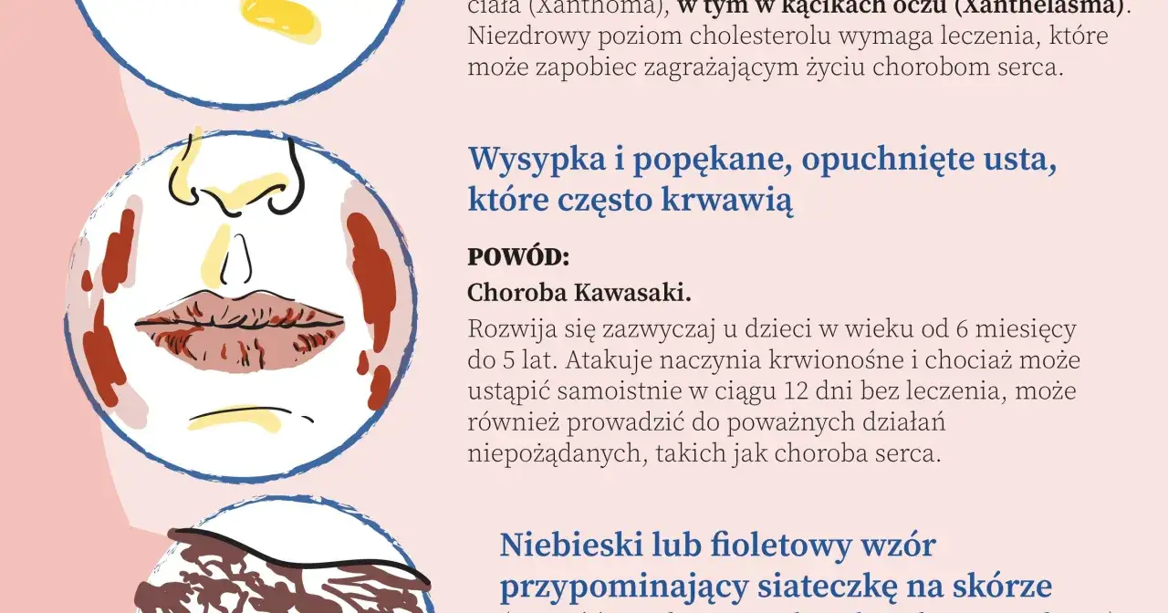 Ilustracja przedstawia twarz z opuchniętymi ustami, objawem choroby Kawasaki, która może wpływać na serce człowieka.