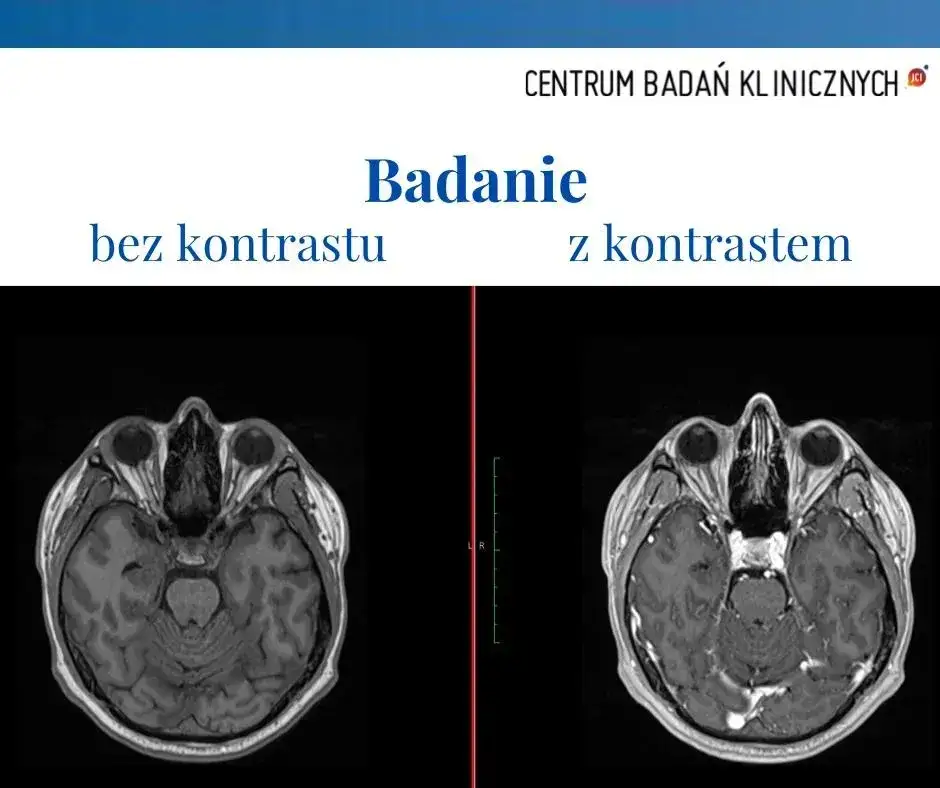 Zdjęcie Czy po rezonansie można pić alkohol? Ważne informacje dla pacjentów
