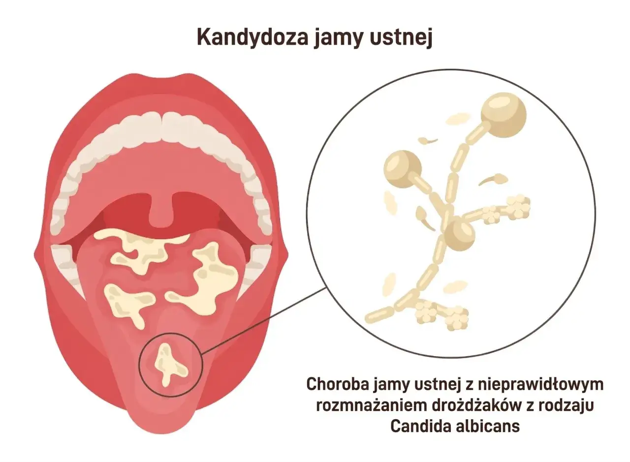 Ilustracja przedstawia jamę ustną z białymi nalotami, objaw zapalenia jamy ustnej. Powiększony fragment ukazuje drożdżaki Candida albicans.
