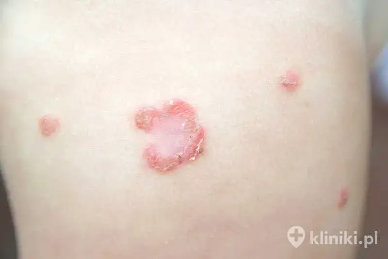 Zdjęcie Czy gronkowiec jest zakaźny? Poznaj objawy i drogi zakażenia - poradnik