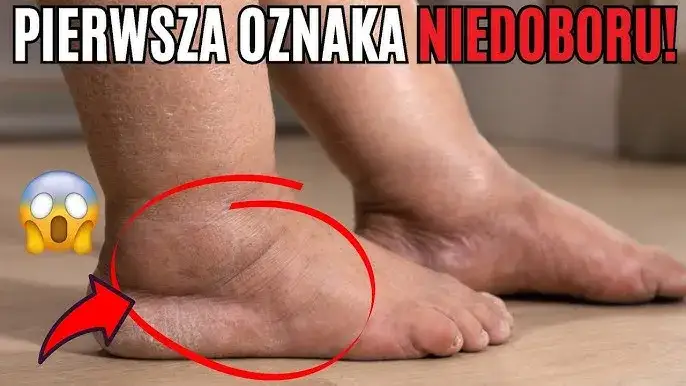 Zdjęcie Niedobory białka objawy: poznaj skutki braku białka w organizmie