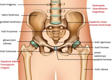 Anatomia miednicy z zaznaczonym stawem biodrowym, kością krzyżową i udową. Widoczne zapalenie kaletek i przeciążenie ścięgien.