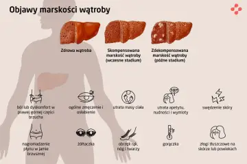 Ilustracja przedstawia objawy marskości wątroby: ból brzucha, zmęczenie, utratę masy ciała, żółtaczkę, obrzęki, gorączkę i swędzenie skóry.