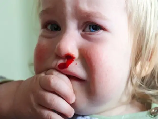 Krew z nosa przyczyny: poznaj najczęstsze powody i objawy