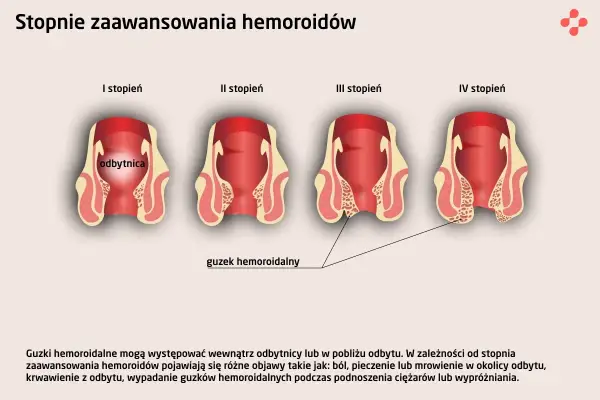 Objawy hemoroidów - Kiedy to coś więcej niż hemoroidy?