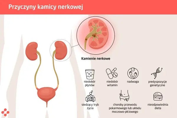 Przyczyna kamicy nerkowej – poznaj czynniki ryzyka i ich skutki