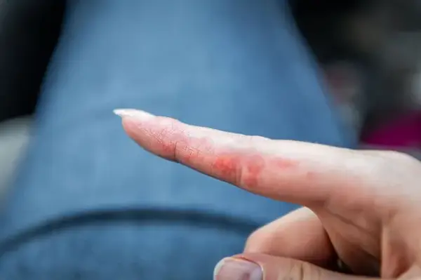 Czy biała czekolada uczula? Sprawdź, jakie są objawy alergii