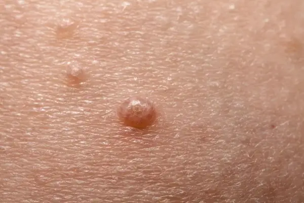 Jakie są objawy mięczaka zakaźnego? Poznaj 7 najczęstszych symptomów