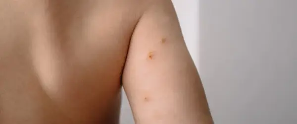 Mięczak zakaźny - poznaj przyczyny, objawy i sposoby skutecznego leczenia