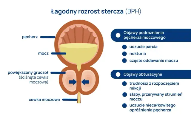 Ilustracja przedstawia łagodny rozrost stercza (BPH), gdzie powiększony gruczoł uciska cewkę moczową, powodując objawy podrażnienia i obturacyjne.