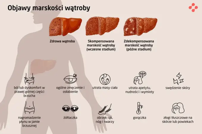 Marskość wątroby - objawy, które łatwo przeoczyć. Sprawdź!