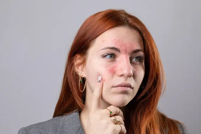 Pierwsze objawy tocznia - jak je rozpoznać?